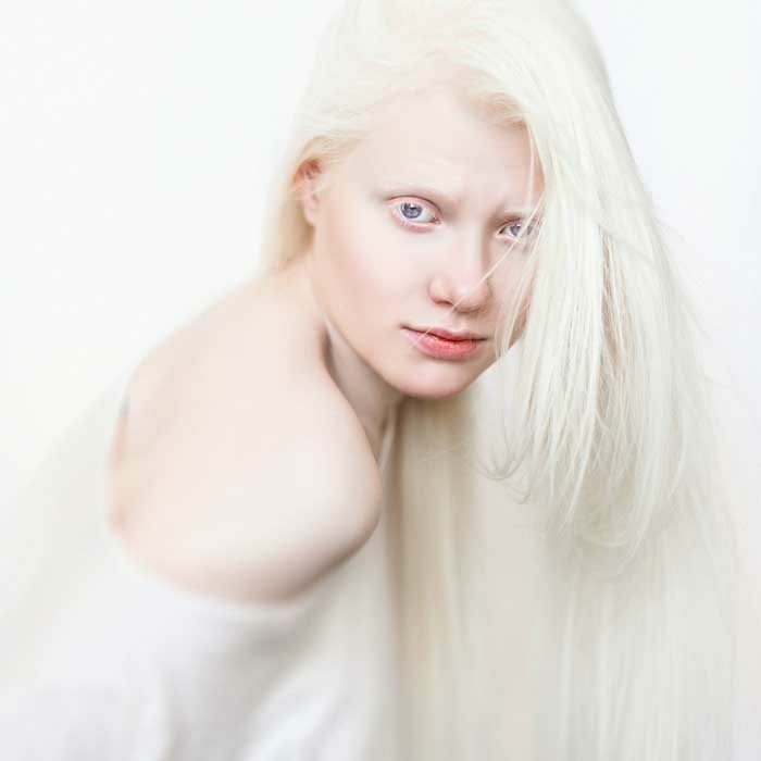 Albinolar ve Albinzm - Resim : 1