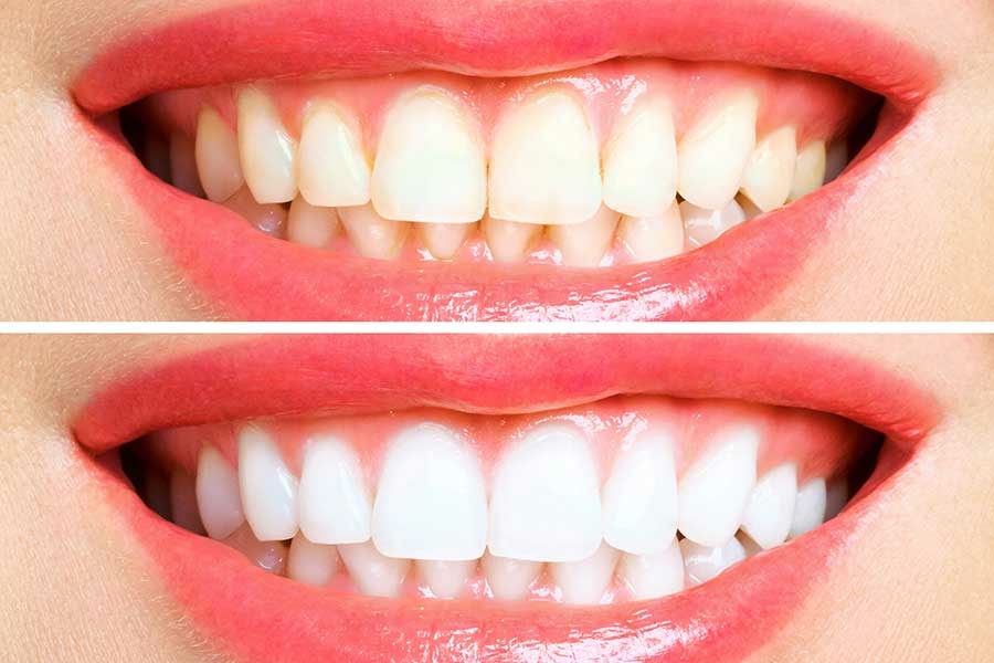 Herkesin Öğrenmesi Gereken Diş Beyazlatıcı Taktikler - Resim : 1